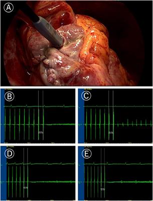 Effect of electrophysiological mapping on non-transmural annulus ablation and atrial fibrillation recurrence prediction after 6 months of Cox-Maze IV procedure